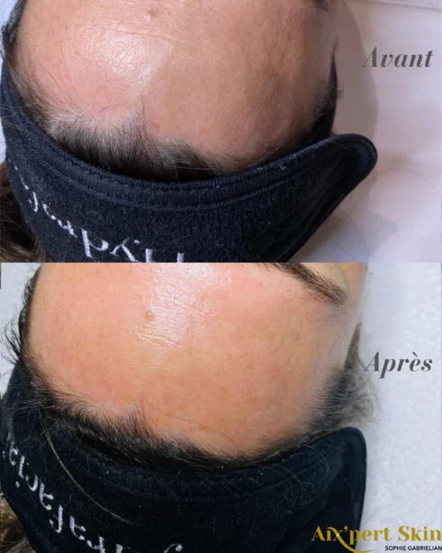✨ Et si une seule séance suffisait pour transformer votre peau ? ✨

Voici le résultat bluffant d’un soin Hydrafacial réalisé chez Aixpert Skin, votre institut de soins avancés à Aix-en-Provence 💆‍♀️

Grâce à une technologie de pointe, Hydrafacial agit en 3 étapes ultra efficaces :

1️⃣ Nettoyage & exfoliation douce
2️⃣ Aspiration indolore des impuretés et points noirs
3️⃣ Hydratation intense avec des sérums riches en antioxydants, peptides et acide hyaluronique 💧

✅ Résultats immédiats :
— Peau plus lumineuse
— Pores visiblement resserrés
— Grain de peau affinité 
— Sensation de fraîcheur et de pureté ✨

Ce soin convient à tous les types de peaux, même sensibles, et il est 100% personnalisable selon vos besoins 💖

📍 Chez Aixpert Skin, nous vous accompagnons avec expertise et bienveillance pour révéler l’éclat naturel de votre peau.

📅 Réservez votre séance et offrez à votre peau le soin qu’elle mérite 🌸

#AixpertSkin #HydrafacialAix #AvantAprès #PeauLumineuse #SoinVisageAix #GlowUp #EsthétiqueAvancée #SkinCareRoutine